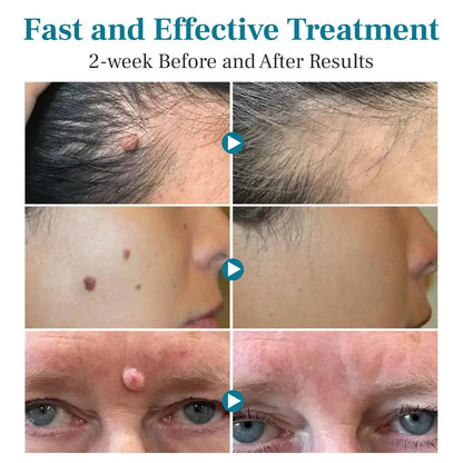 LÁPIZ LÁSER PARA ELIMINAR VERRUGAS Y LUNARES